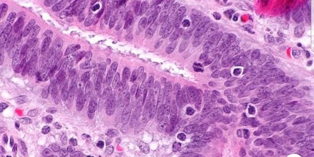 Hanno ucciso il cancro al seno con metastasi per la prima volta: cosa sono le cellule immunitarie