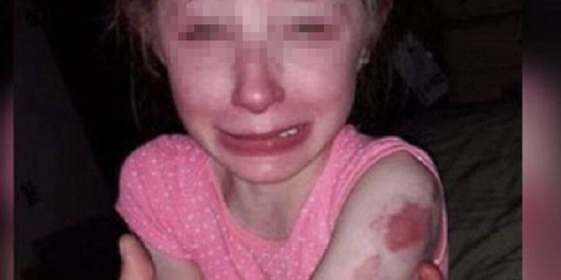 Bimba di 10 anni in lacrime torna da scuola piena di morsi su tutto il corpo