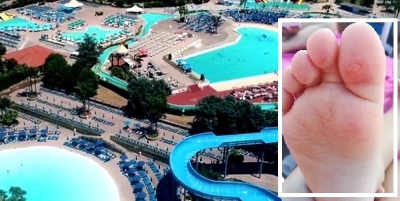 “Bolle e sangue sui piedi dei bambini”, testimonianze dalla piscina del Pareo Park