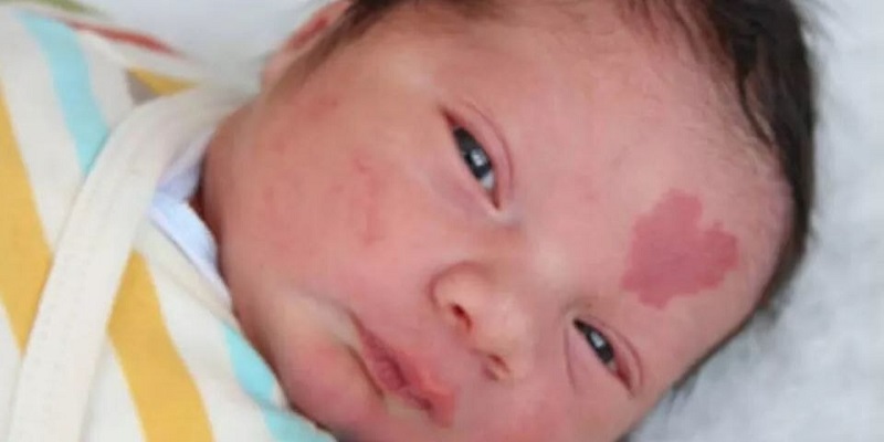 Cinar è nato con una voglia a forma di cuore sulla fronte: ecco com’è oggi (Foto)