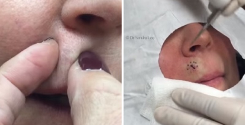 Ha trascurato un punto nero sul labbro e si forma come un sasso, l’intervento del medico (Video)