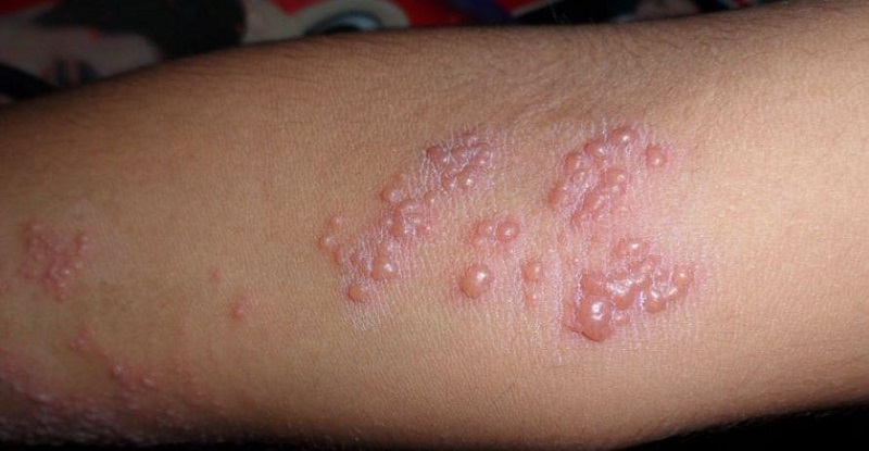 Herpes zoster, lo stress può attivarlo: la malattia della varicella colpisce una persona su 3