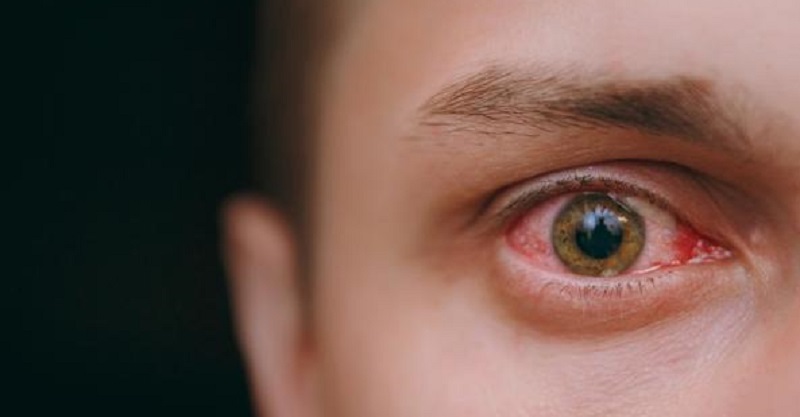 “Attenzione agli occhi”, Coronavirus: gli altri sintomi oltre febbre e tosse