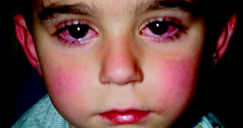 Sindrome Kawasaki, i consigli dei pediatri: “Ecco i sintomi spia”