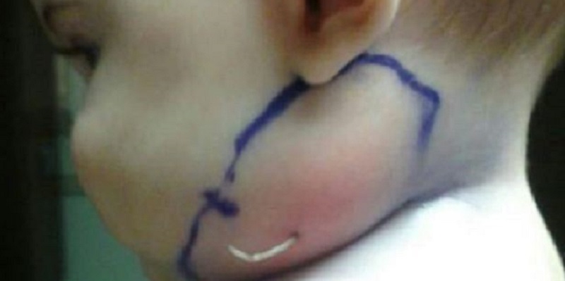 Bimba di 7 mesi con uno strano gonfiore, gli spunta come un bastoncino: ecco cosa c’era nella sua faccia