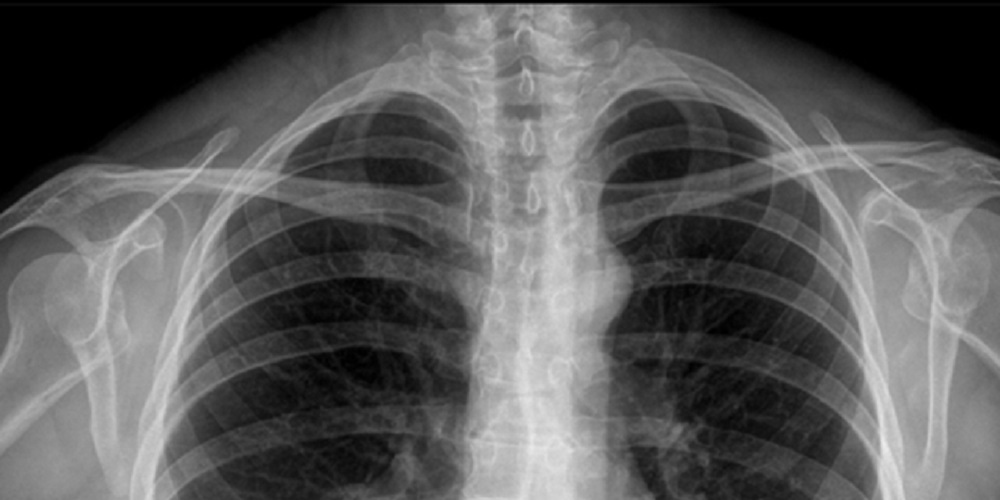 L’allarme degli esperti: polmoni post covid e polmoni dei fumatori (Foto)