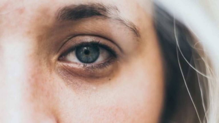 Occhiaie scure: potrebbero essere il campanello d’allarme di una grave carenza | Si rischiano importanti malattie