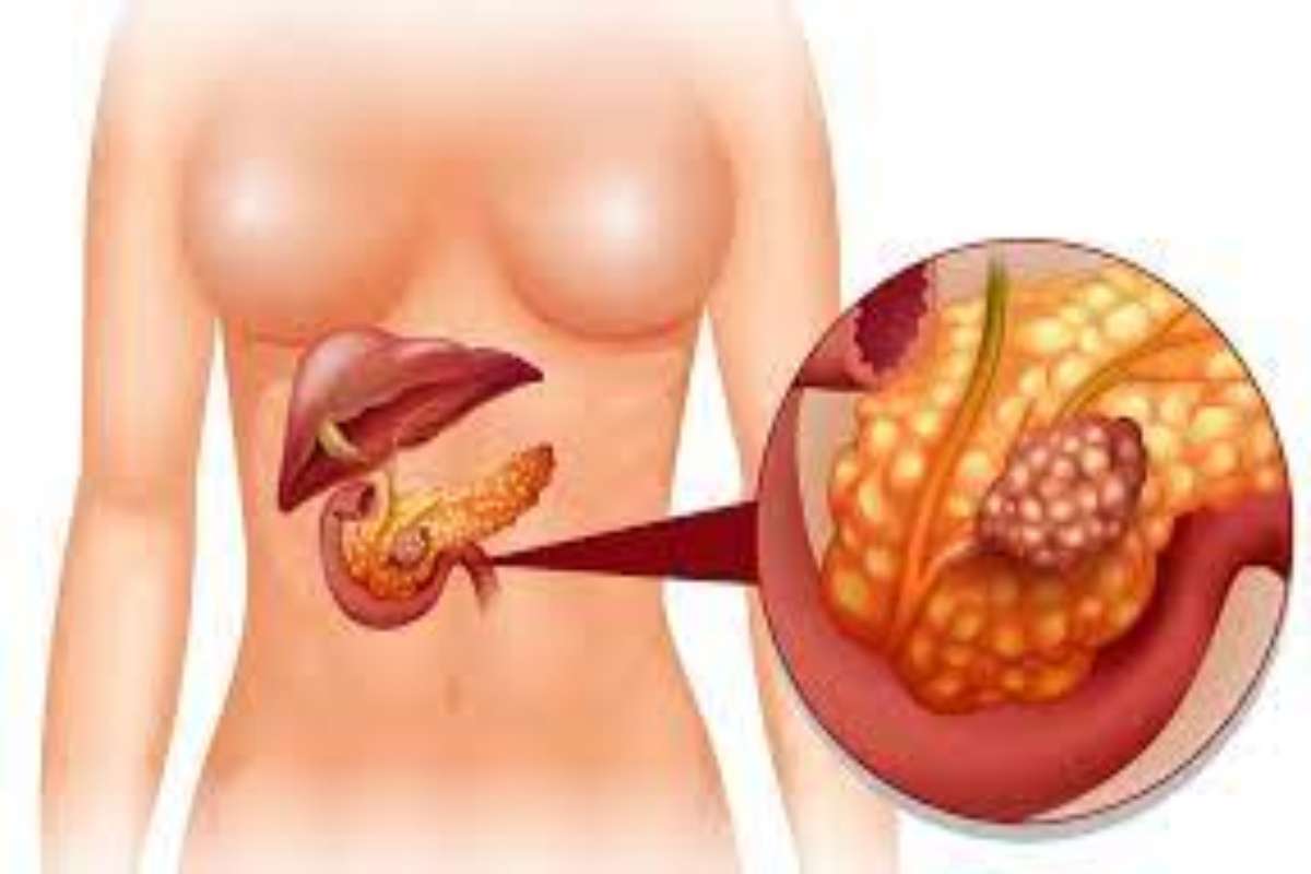 Tumore al pancreas: scoperta un’incredibile cura| Ecco di cosa si tratta