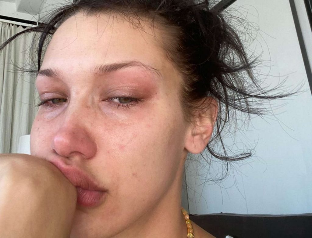 Bella Hadid parla della sua malattia su TikTok: “Ecco cosa mi causa il morbo di Lyme”